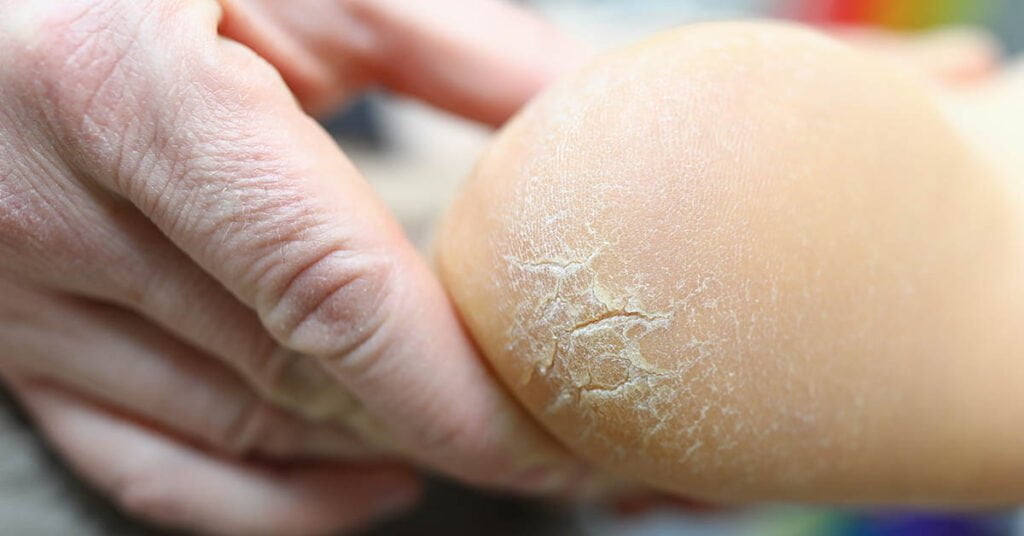 Hielkloven – scheuren en barsten in de huid van de hiel